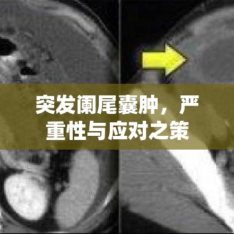 突发阑尾囊肿，严重性与应对之策